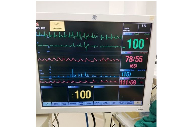 Успешно извршена уште една трансплантација на срце ?
