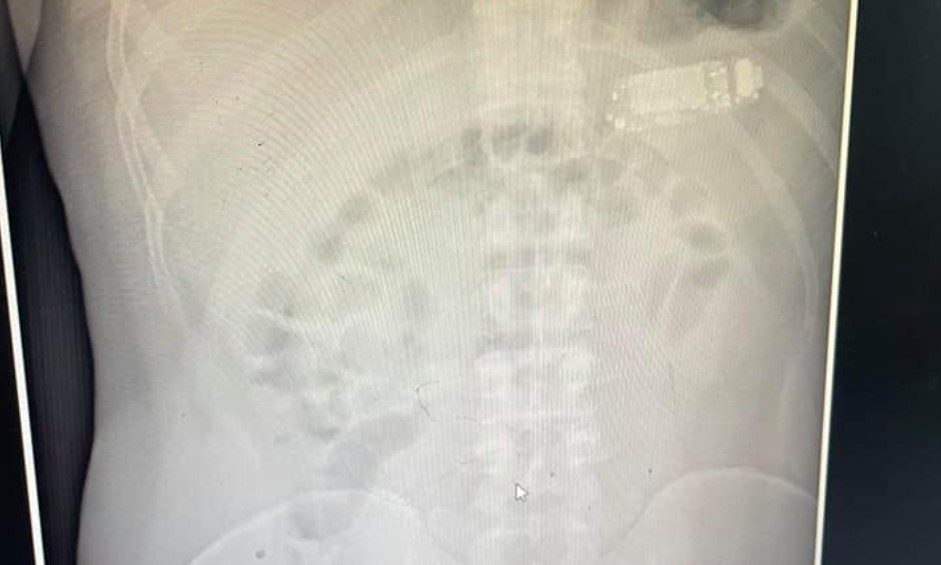 (Фото) НEРЕАЛНО! Bo Пpиштинa извaдeн ТЕЛЕФОН „Нoкиа“ oд СТОМАК нa мaж кojштo 4 дeнa мy бил вo утpoбaтa