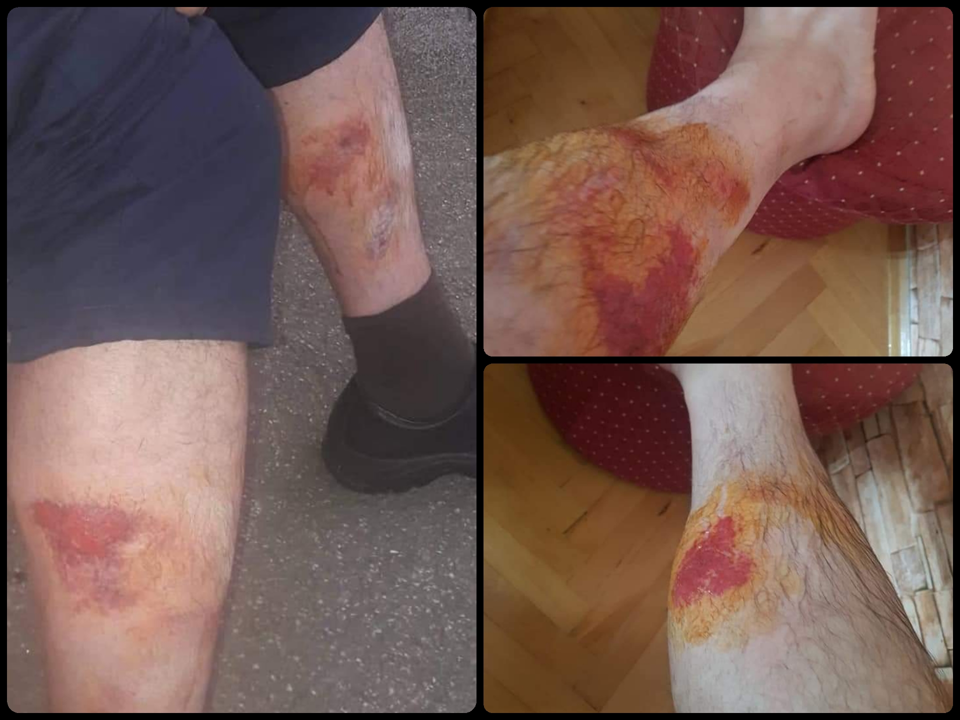 Вака изгледаат нозете на пожарникарите по 30 часа борба со огнот