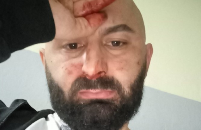 Му дофрлале ‘педер’, ‘ќе гориш во пеколот’ па го нападнале, Беким Асани претепан во Тетово