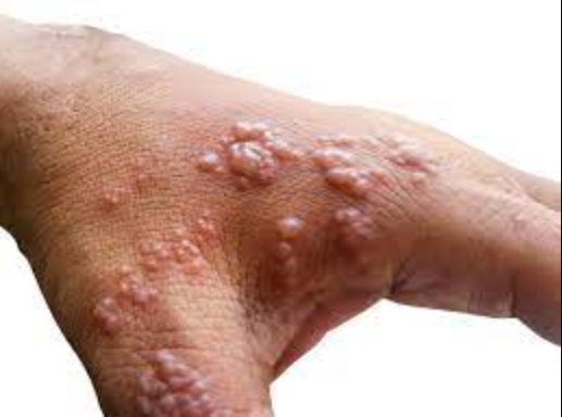 Откриени уште два симптома кои укажуваат на мајмунски сипаници