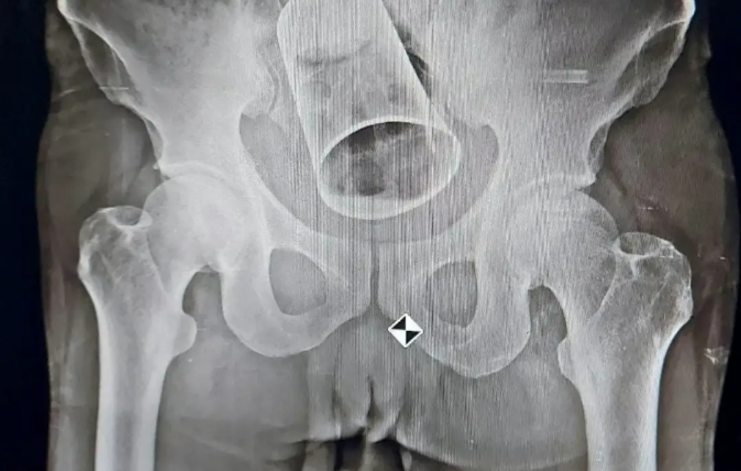 Бизарен болнички случај: Рентген снимката ги оставила докторите во ШОК, а еве што извадиле од пациентот после 2 часа операција