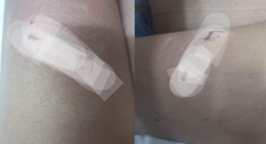 Активистка за заштита на животни искасана од глутница кучиња во центарот на Струга