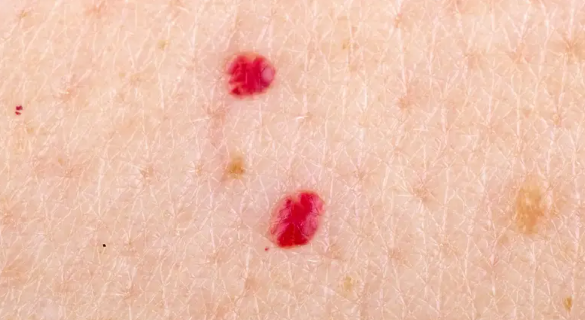 Знаете ли зошто се појавуваат овие црвени точки на вашата кожа? Еве во кој случај треба веднаш да посетите доктор