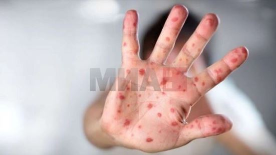 Две девојчиња во Тексас починаа од сипаници, верска заедница одбива вакцини