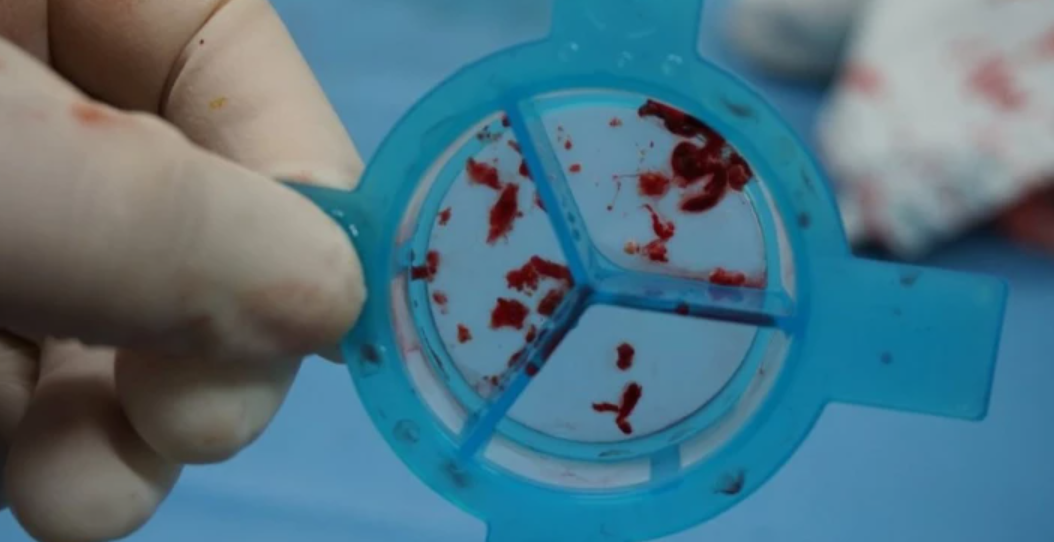 Ова е првиот знак дека во телото ви се формирал тробм! Никако не смеете да го игнорирате