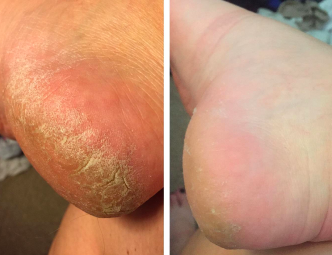 Ова е најлесен начин да се ослободите од непосакувани габички и испукани пети