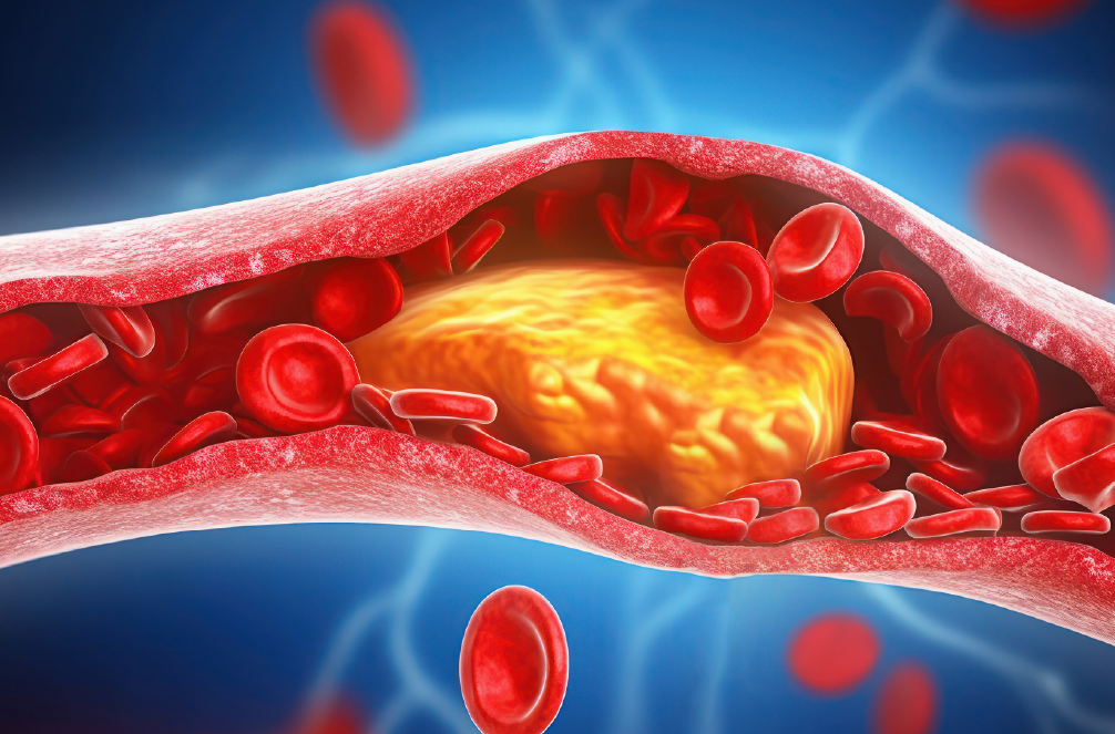 Препознајте ги тивките знаци на висок холестерол на вашето тело: Обрнете внимание на овие симптоми