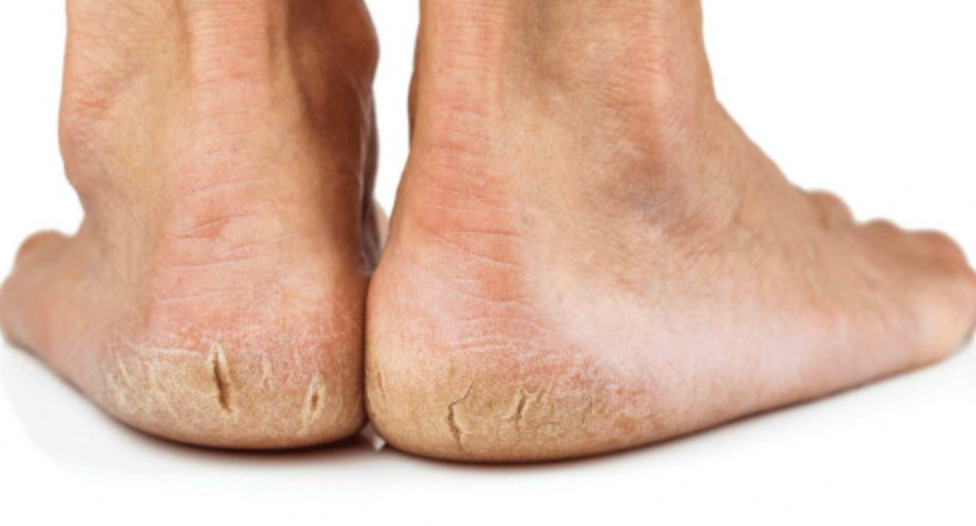 Со помош на само една намирница, ослободете се од испуканите пети