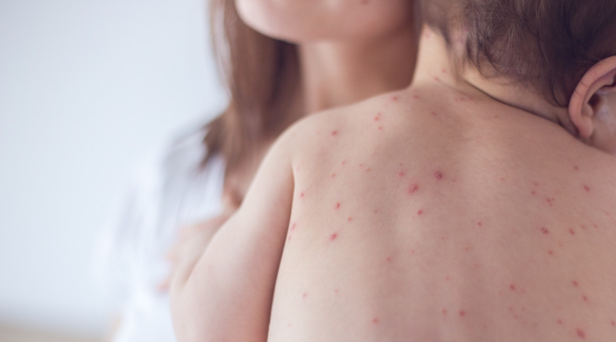 Голема епидемија на најзаразниот вирус во САД и во Европа