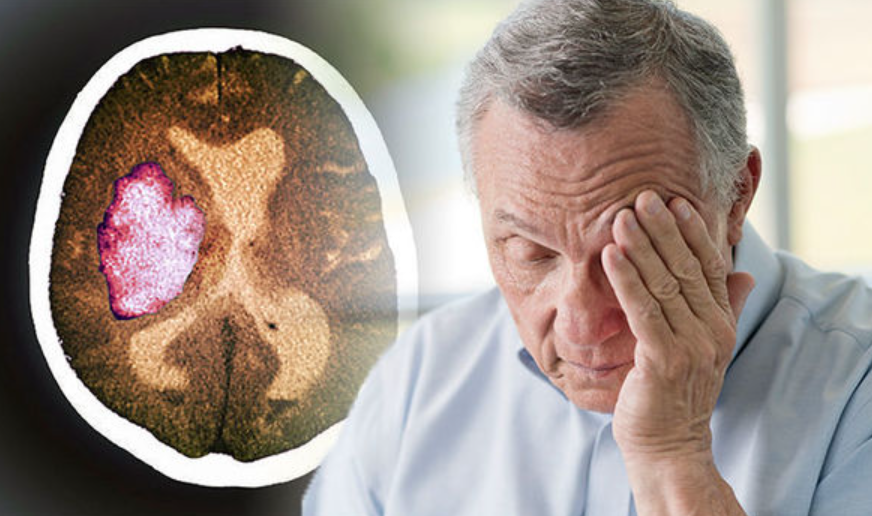 СИМПТОМИ НА МИНИ МОЗОЧЕН УДАР: Препознајте ги навреме и веднаш побарајте лекарска помош