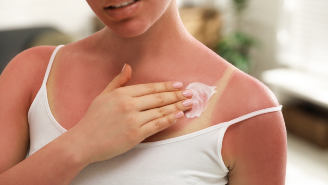 Изгоревте од сонце? Овој трик може да ви помогне за само половина час