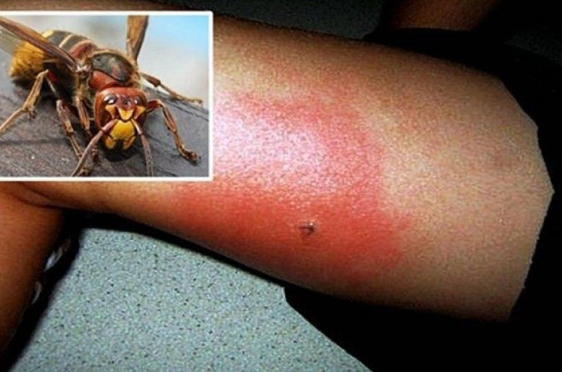 Убод од стршлен може да предизвика гушење за само неколку минути – еве што треба да направите додека стигне помошта