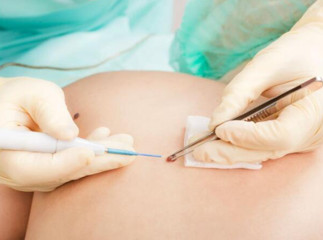 Лекар предупредува: Доколку забележите ваква промена на кожата – веднаш одете на лекар!