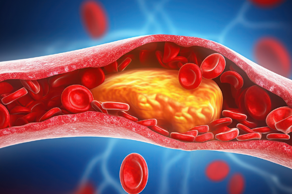 Три знаци кои укажуваат дека имате опасно висок холестерол – првиот никако не смеете да го игнорирате!